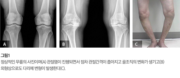 그림1 -정상적인 무릎의 사진이며(A) 관절염이 진행되면서 점차 관절간격이 좁아지고 골조직의 변화가 생기고(B) 외형상으로도 다리에 변형이 발생한다(C).