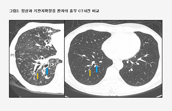 그림2. 정상과 기관지확장증 환자의 흉부 CT사진 비교