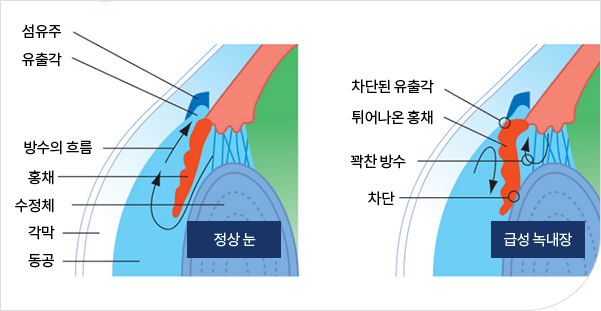 좌측(정상눈) : 섬유주, 유출각, 방수의 흐름, 홍채, 수정체, 각막, 동공 / 우측(급성 녹내장) : 차단된 유출각, 튀어나온 홍채, 꽉찬 방수, 차단