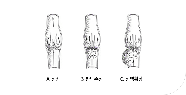 하지정맥류란