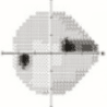 초기 녹내장 시야검사