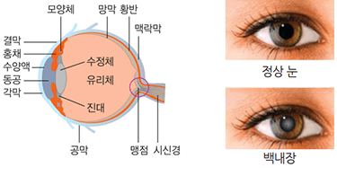 눈의 구조 및 백내장 : (좌) 결막,홍채,수양액,동공,각막,모양체,망막,황반,맥락막,수정체,유리체,진대,공막,맹점,시신경 / (우) 정상눈, 백내장