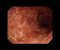 궤양성 대장염(2)