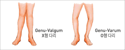 O자형, X자형 다리 치료