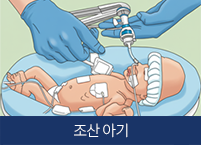 조산아기 이미지