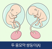 두 용모막 쌍둥이(A)이미지