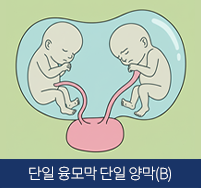두 용모막 쌍둥이(B)이미지