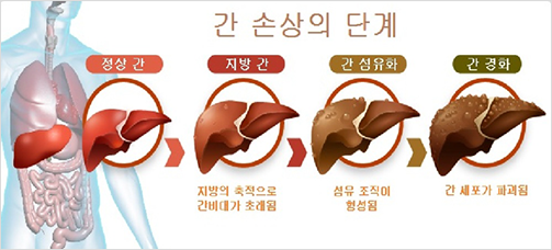 간 섬유화 정도 정상간 간경병:심환 섬유화