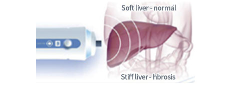 간섬유화 및 지방간 스캔검사