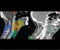 두경부암 치료계획 영상